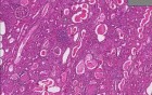 Chronic glomerulonephritis