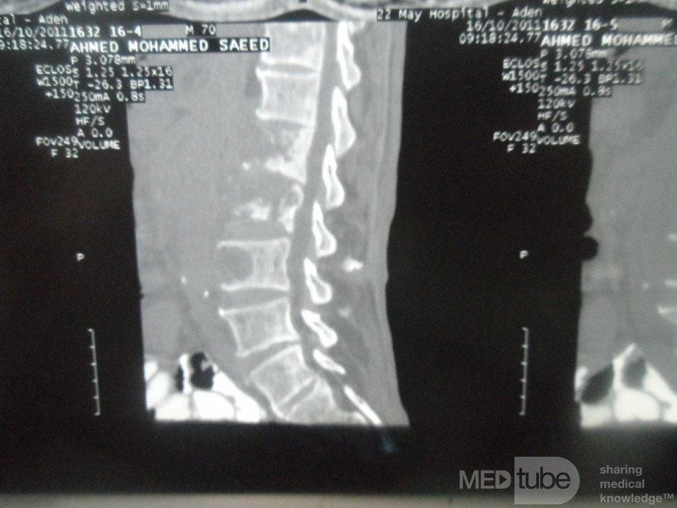 Pancreas cancer - 10