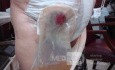 Ileal Neobladder Substitution (ileal bladder) (9 of 9)