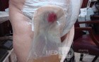 Ileal Neobladder Substitution (ileal bladder) (9 of 9)