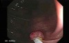 Colonoscopic polyp removal