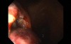 Gastrointestinal Stromal Tumor - GIST (24 of 65)