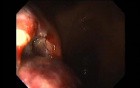Gastrointestinal Stromal Tumor - GIST (24 of 65)