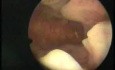 Hysteroscopic Aspect Of Endometrial Hyperplasia
