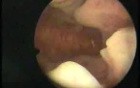 Hysteroscopic Aspect Of Endometrial Hyperplasia