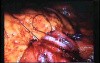 Jejunal Gastrointestinal Stromal tumor (GIST) (69 of 86)
