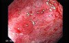 Colonic Lymphoma (3 of 6)