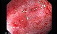 Colonic Lymphoma (3 of 6)