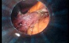Gastrointestinal Stromal Tumor - GIST (23 of 65)