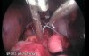 Door Surgery Of Hiatal Hernia