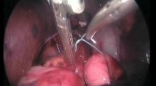 Door Surgery Of Hiatal Hernia
