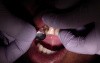 Anterior Composite Metal Kidney Matrix