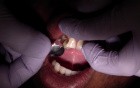 Anterior Composite Metal Kidney Matrix