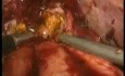 Redo Hepaticojejunostomy - Laparoscopy