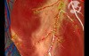 Normal Blood Flow