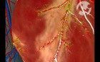 Normal Blood Flow