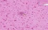 Viral Encephalitis