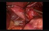 Laparoscopic Nissen Fundoplication 