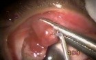 Pedunculated Hemangioma - Fugo Blade Cut