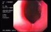 Mallory-Weiss Tear - Ulcer at the Gastroesophageal Junction