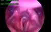 Stridor In Stroboscopy