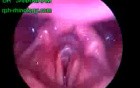 Stridor In Stroboscopy