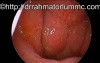 Ipsilateral Eustachian Tube Discharge