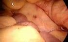 Sigmoid resection - laparoscopy