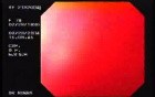Variceal Hemorrhage - Status Post Banding