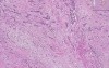 Bladder - Urothelial Carcinoma Grade III
