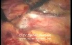 Para aortic LN dissection - Laparoscopic Approach