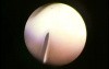 Botox bladder injection - urological simulator