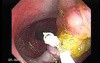 Colonoscopic Polypectomy (12 of 29)