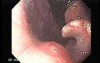 Zenker's Diverticulum - Retroflexed Image of the Nasopharynx
