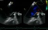 Mitral Regurgitation