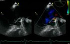 Mitral Regurgitation