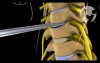 Cervical Discectomy and Fusion