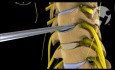 Cervical Discectomy and Fusion