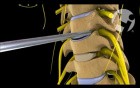 Cervical Discectomy and Fusion