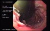 Lower Esophageal (Schatzki) Ring with esophageal varices and Reflux Esophagitis (2 of 2)