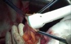 Sigmoid and rectal resection