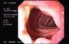 Diverticulitis Of The Sigmoid (1 of 2)