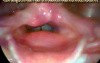 Muscle Tension Dysphonia - MTD
