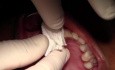 Extraction #8 With Simple Socket Bone Grafting