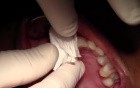 Extraction #8 With Simple Socket Bone Grafting