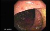 Ulcerative Colitis Complicating Pseudomembranous Colitis (4 of 4)