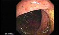 Ulcerative Colitis Complicating Pseudomembranous Colitis (4 of 4)