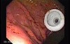 Percutaneous Endoscopic Gastrostomy - PEG (6 of 6)