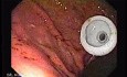 Percutaneous Endoscopic Gastrostomy - PEG (6 of 6)