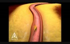 Arterial Stenting - 3D Medical Animation